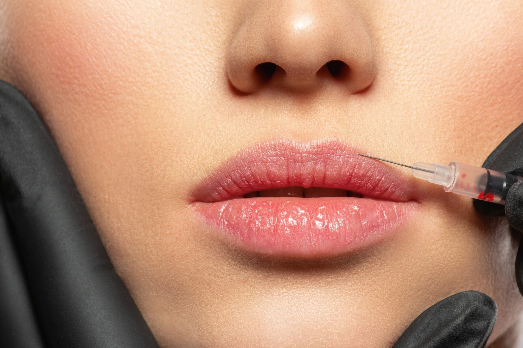 Caucasian woman getting botox cosmetic injection in the lips. Woman gets botox injection in her face